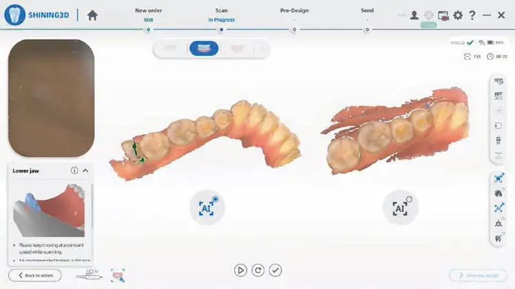 Aoralscan 3 でスキャンした口腔内3D画像