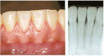 かい歯科の歯周病治療　軽度の歯周病