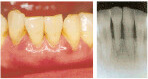 かい歯科の歯周病治療　中程度の歯周病