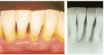 かい歯科の歯周病治療　重度の歯周病